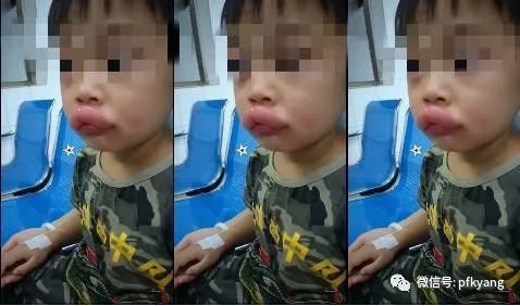 男孩吃葡萄過(guò)敏腫成嘟嘟嘴怎么回事？畫(huà)面詳情曝光網(wǎng)友忍不住笑了